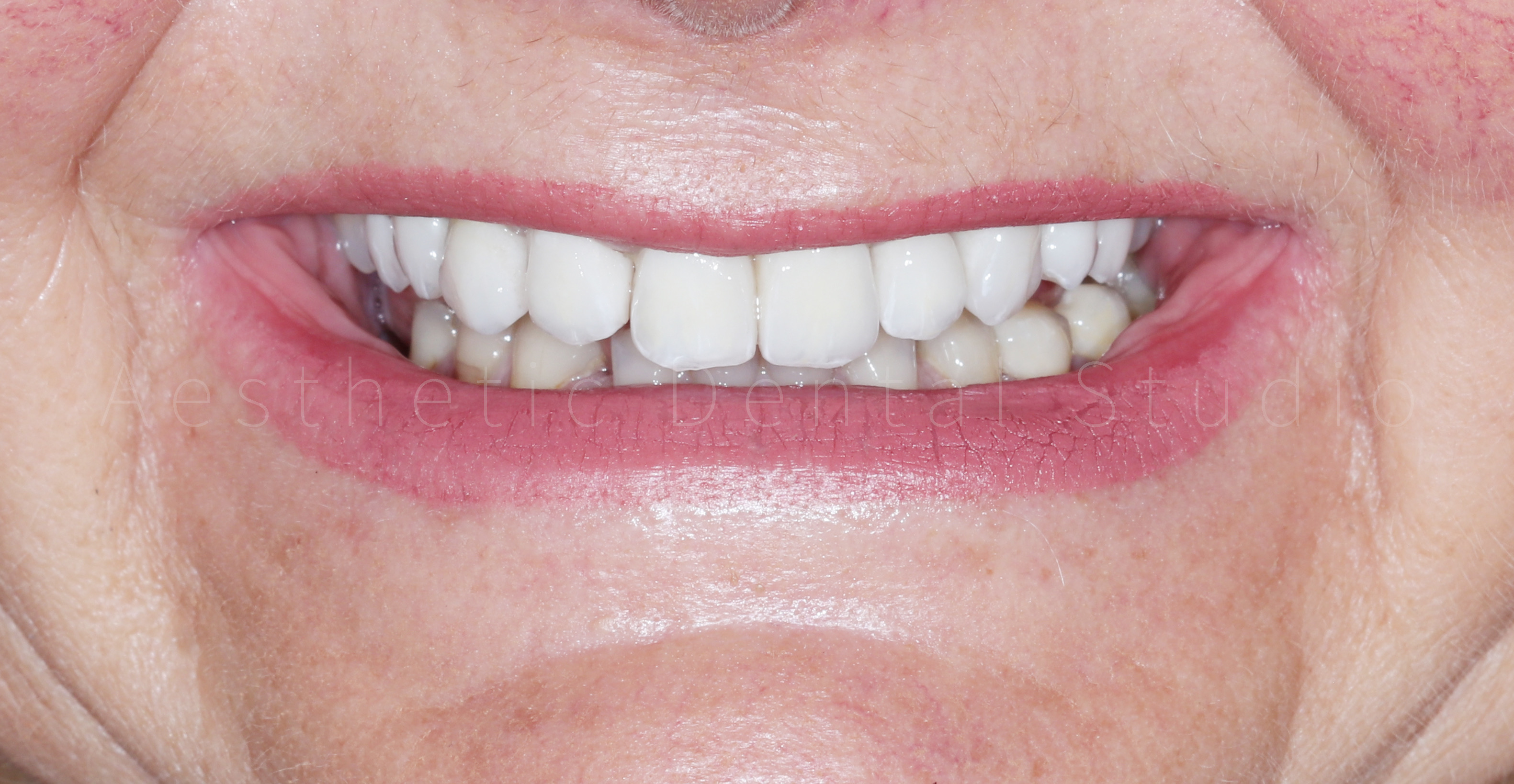 Τελικό αποτέλεσμα – Αισθητικά άρτιες ολοκεραμικές αποκαταστάσεις στα άνω πρόσθια δόντια, με φυσική λάμψη, συμμετρία και αρμονία με τα χαρακτηριστικά του προσώπου