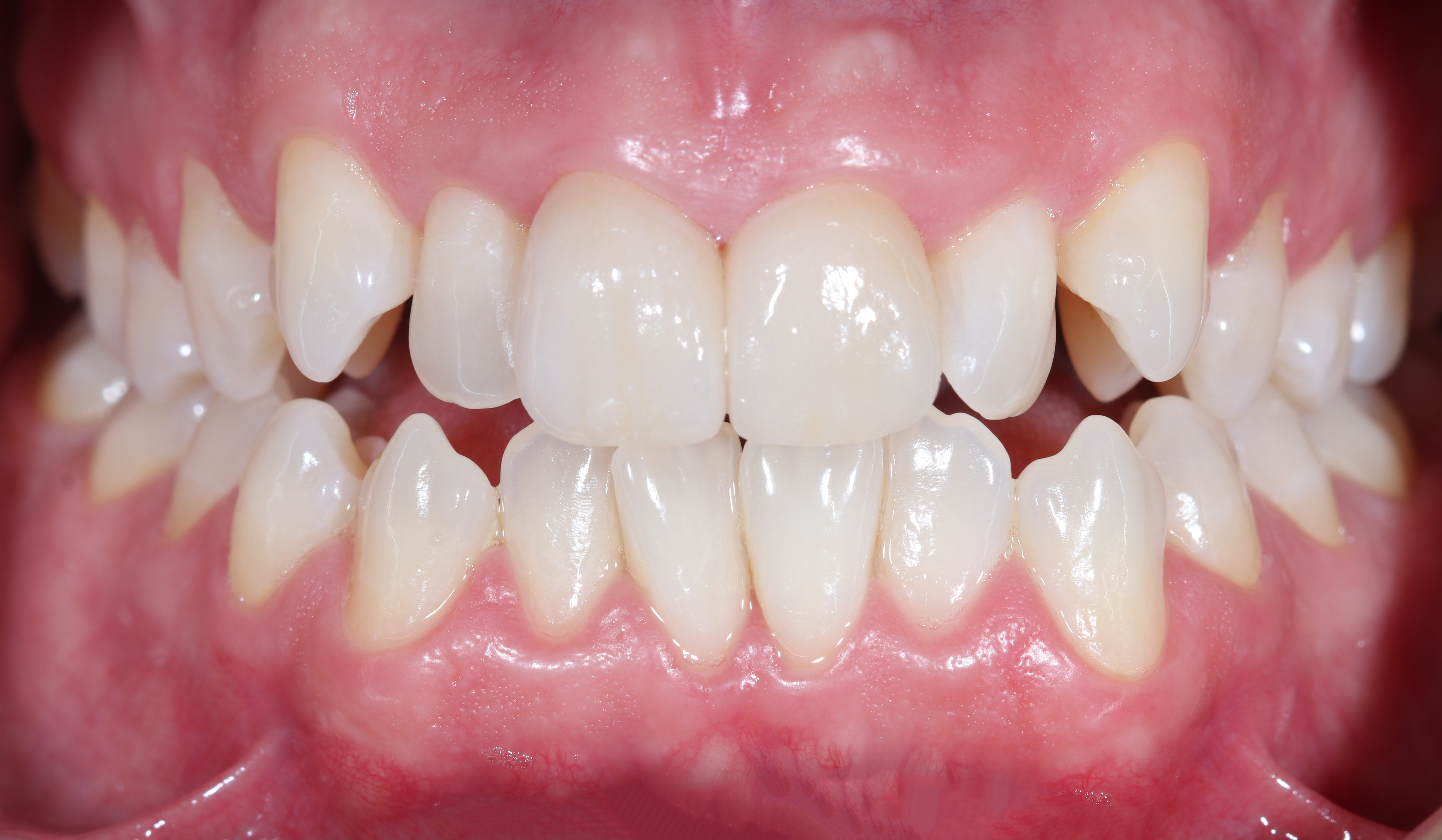 Τελική κατάσταση - Πρόσθια άποψη με τα δόντια σε σύγκλειση