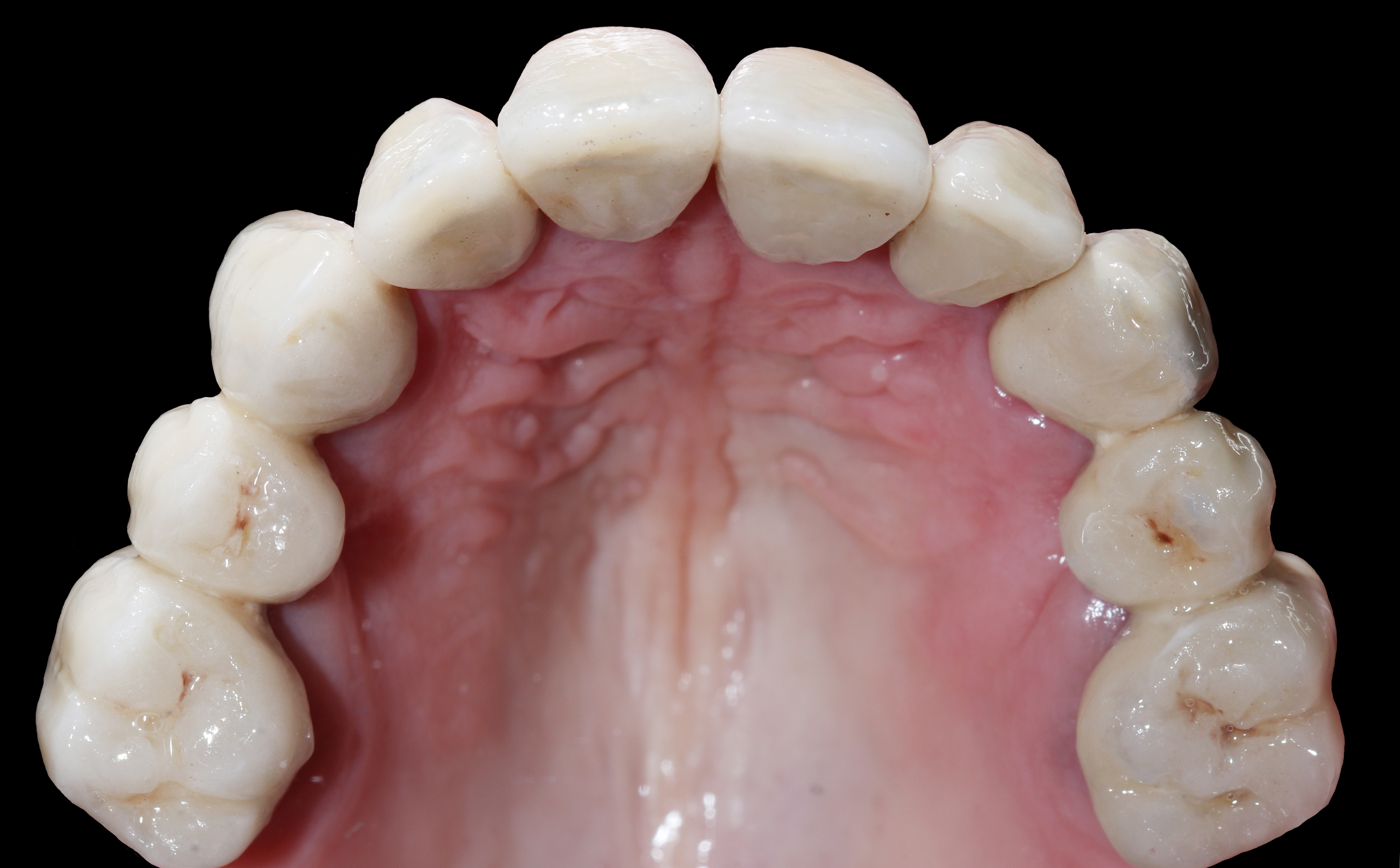 Άνω γνάθος - Μασητική άποψη μετά την αποκατάσταση