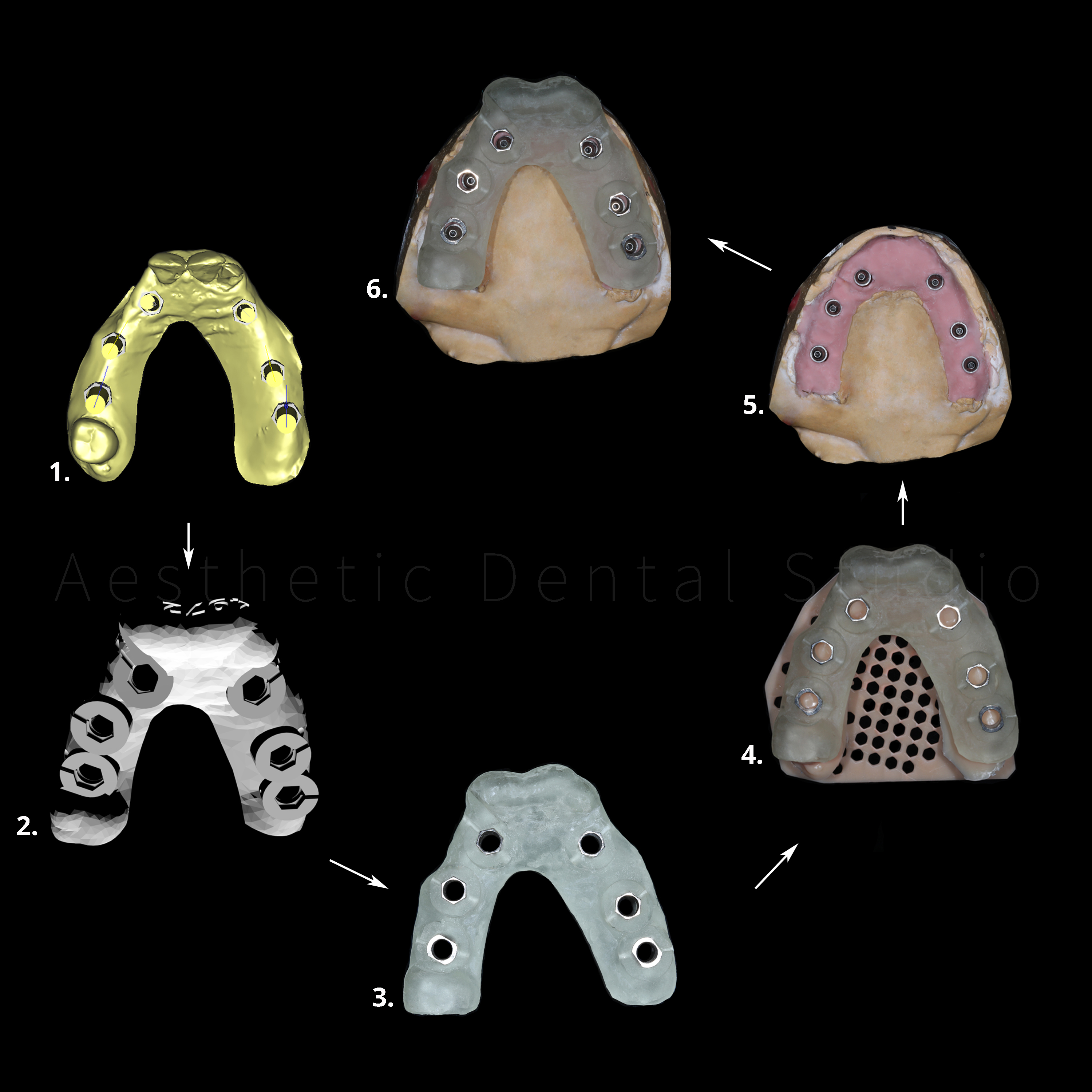 Από τον ψηφιακό σχεδιασμό στην πραγματικότητα — τα στάδια δημιουργίας του χειρουργικού οδηγού και η τελική εφαρμογή του στο εκμαγείο της ασθενούς μετά την τοποθέτηση των εμφυτευμάτων για επαλήθευση της χειρουργκής ακρίβειας