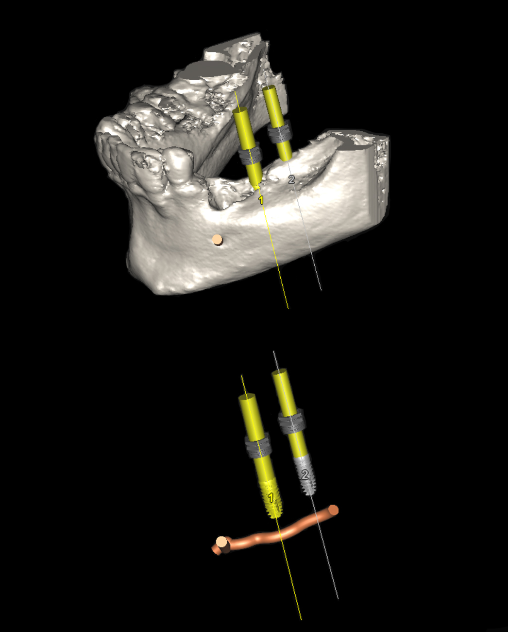 3D αξονική ακτινογραφία - Πάνω: το τρισδιάστατο μοντέλο του οστού της κάτω γνάθου με δύο εμφυτεύματα ψηφιακά τοποθετημένα - Κάτω: Το -ζωτικής σημασίας- κάτω φατνιακό νεύρο και ψηφιακά ομοιώματα των δύο εμφυτευμάτων: Η απόσταση με το νεύρο είναι επαρκής και τα εμφυτεύματα μπορούν να τοποθετηθούν με ασφάλεια
