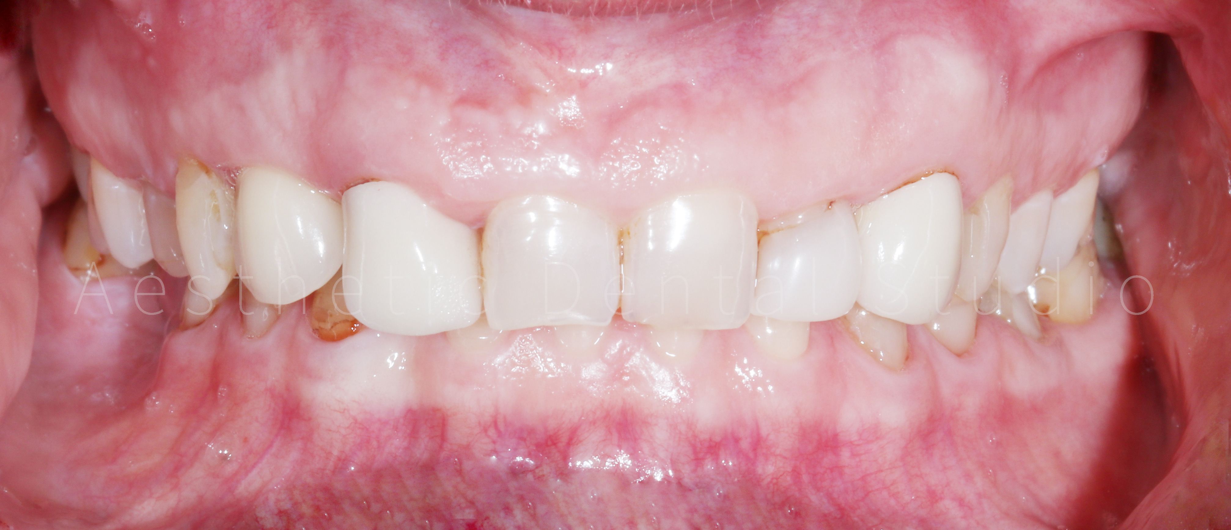 Αρχική ενδοστοματική εικόνα – Φθαρμένα δόντια, ανομοιομορφία στα σχήματα και παλαιές αποκαταστάσεις πριν την αισθητική ανασχεδίαση