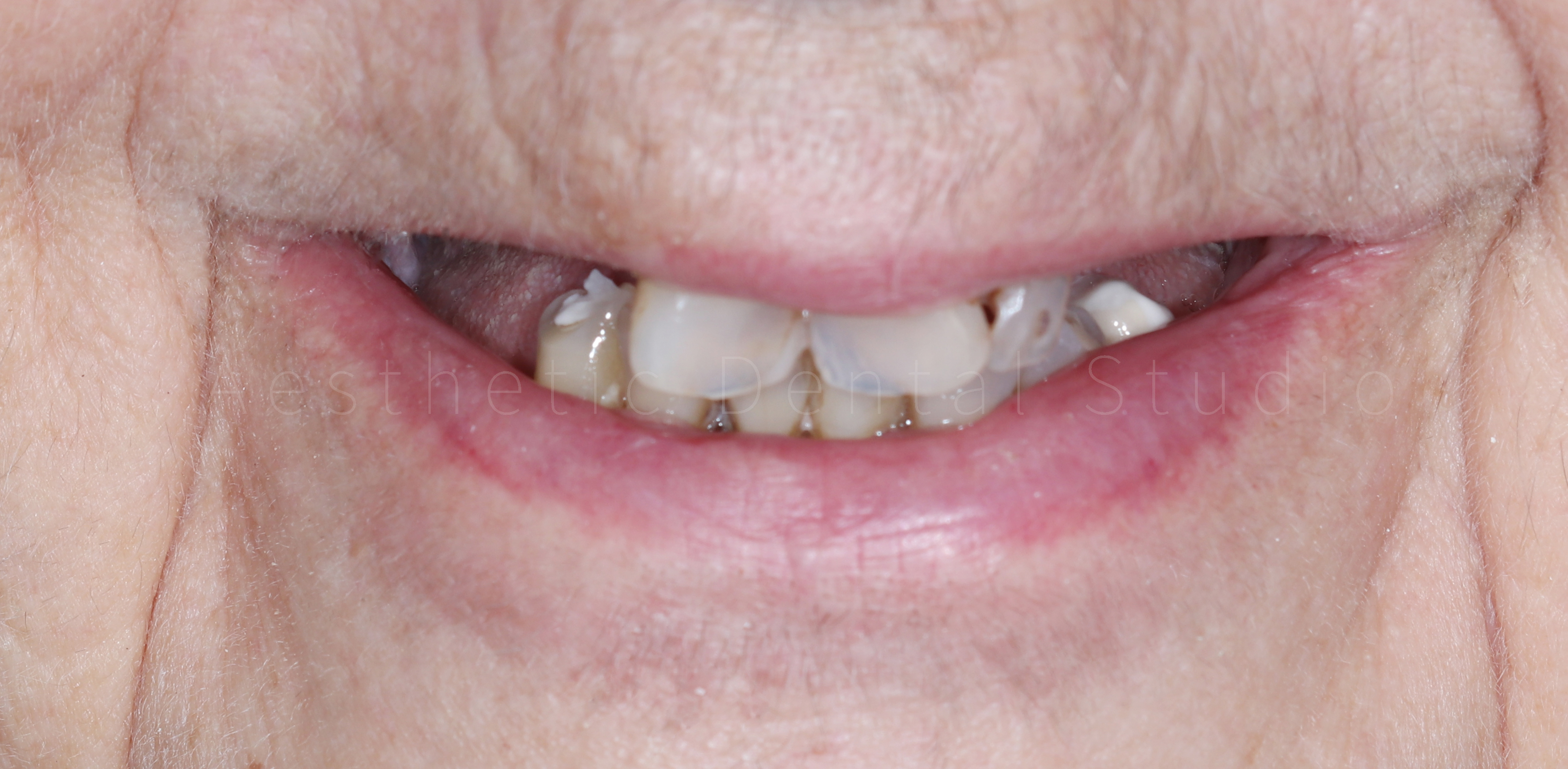 Αρχική κατάσταση — χαμόγελο - εκτεταμένη φθορά και απώλεια δοντιών πριν την έναρξη της θεραπείας