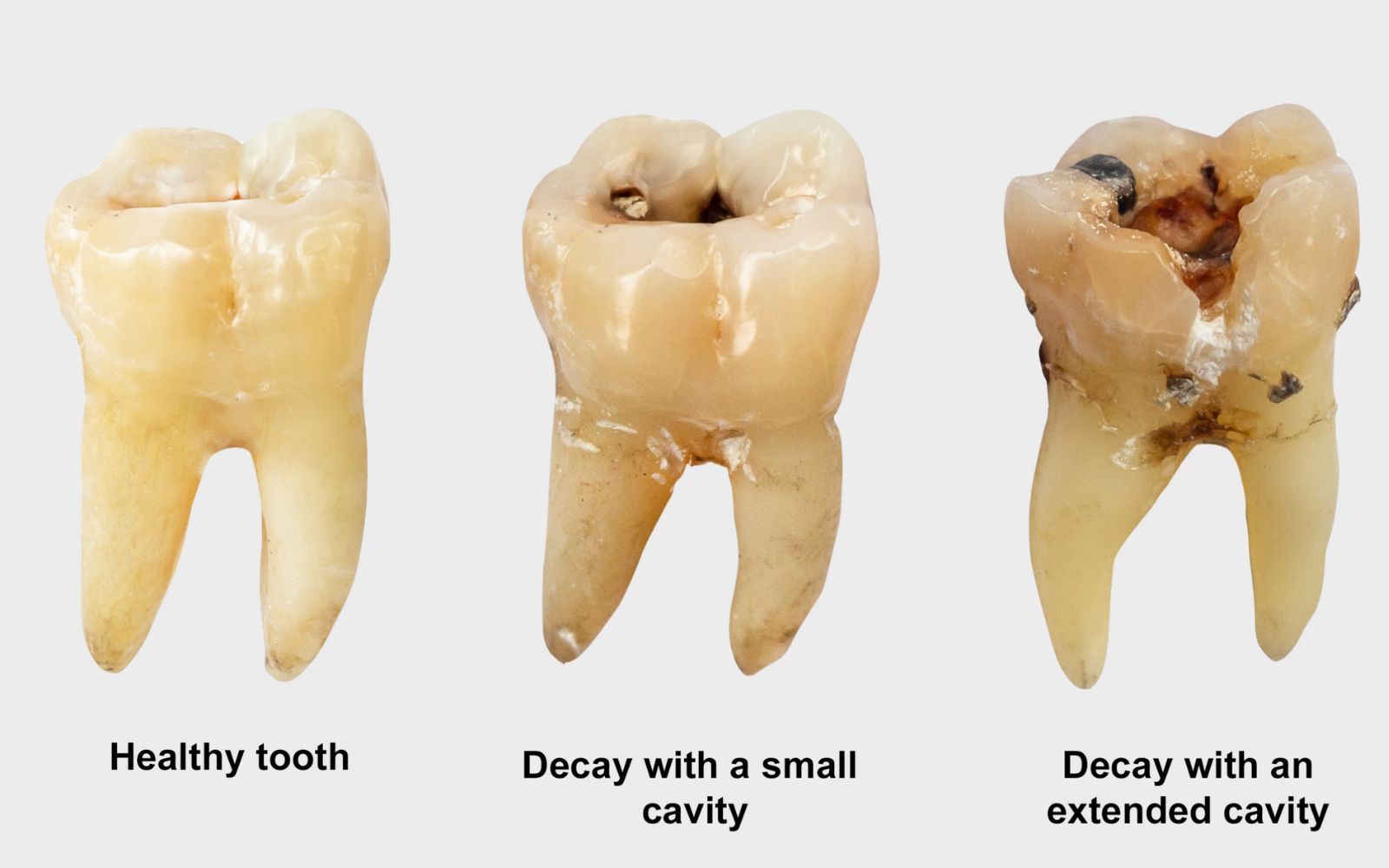 Dental fillings