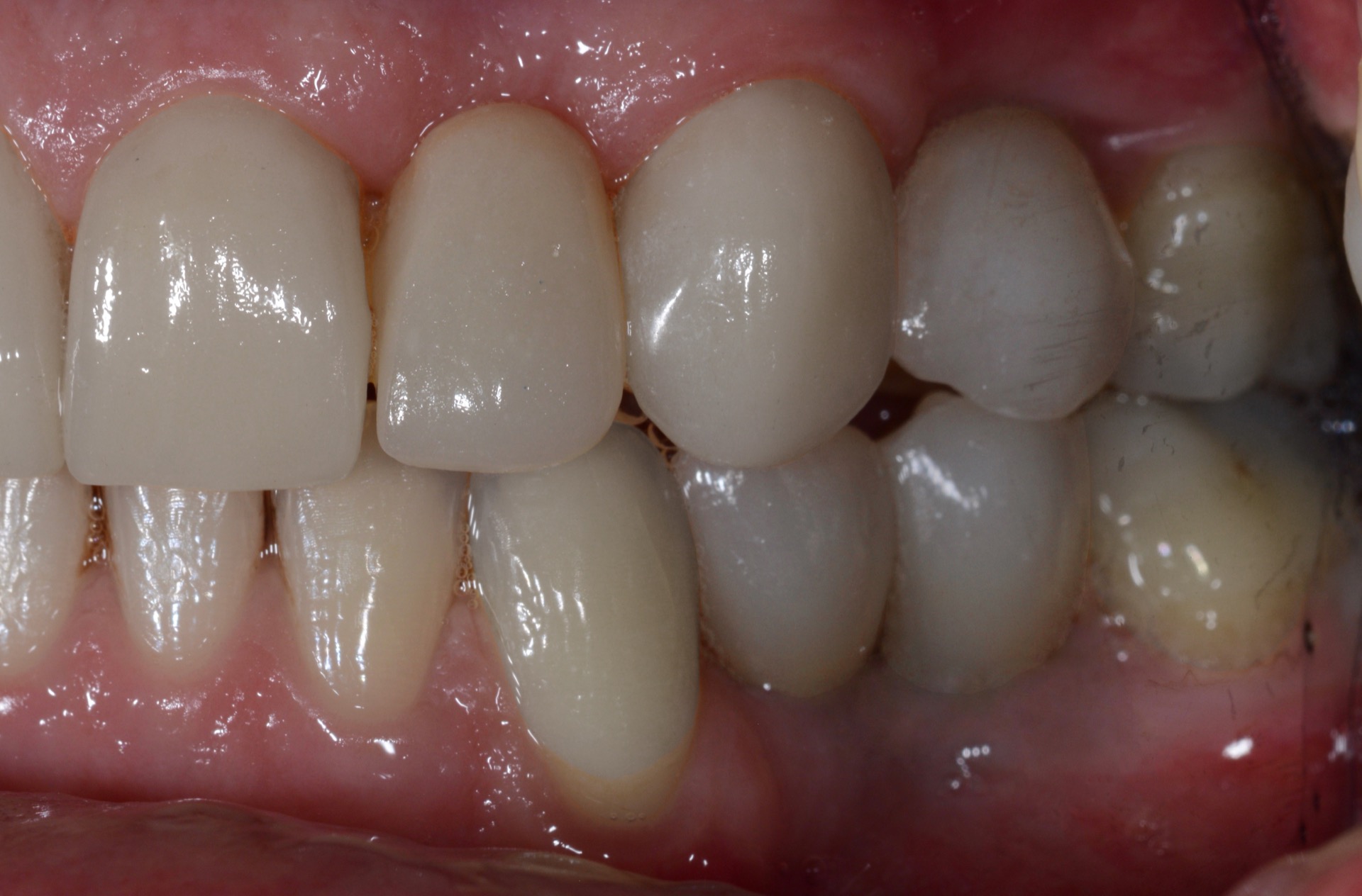 Τελική κατάσταση - Αριστερά άποψη.