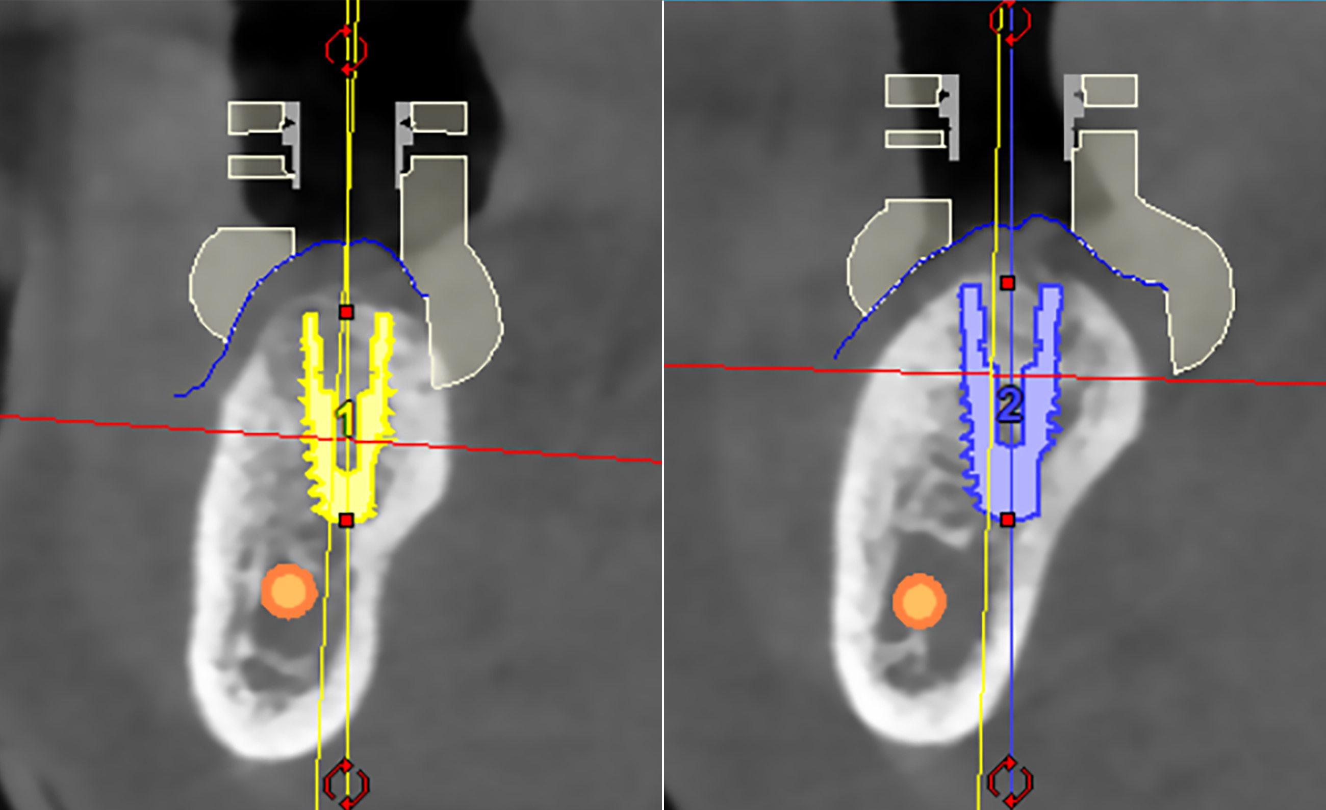 3D αξονική τομογραφία – Εγκάρσιες τομές της κάτω γνάθου της ασθενούς.
Απεικονίζονται τα δύο εμφυτεύματα που τοποθετήθηκαν με τη βοήθεια εξειδικευμένου προεγχειρητικού λογισμικού. Μέσω της ανάλυσης μπορούμε να αξιολογήσουμε τη θέση τους στο οστό, τον προσανατολισμό και τις μεταξύ τους κλίσεις, καθώς και την πιθανή γειτνίασή τους με σημαντικά ανατομικά μόρια