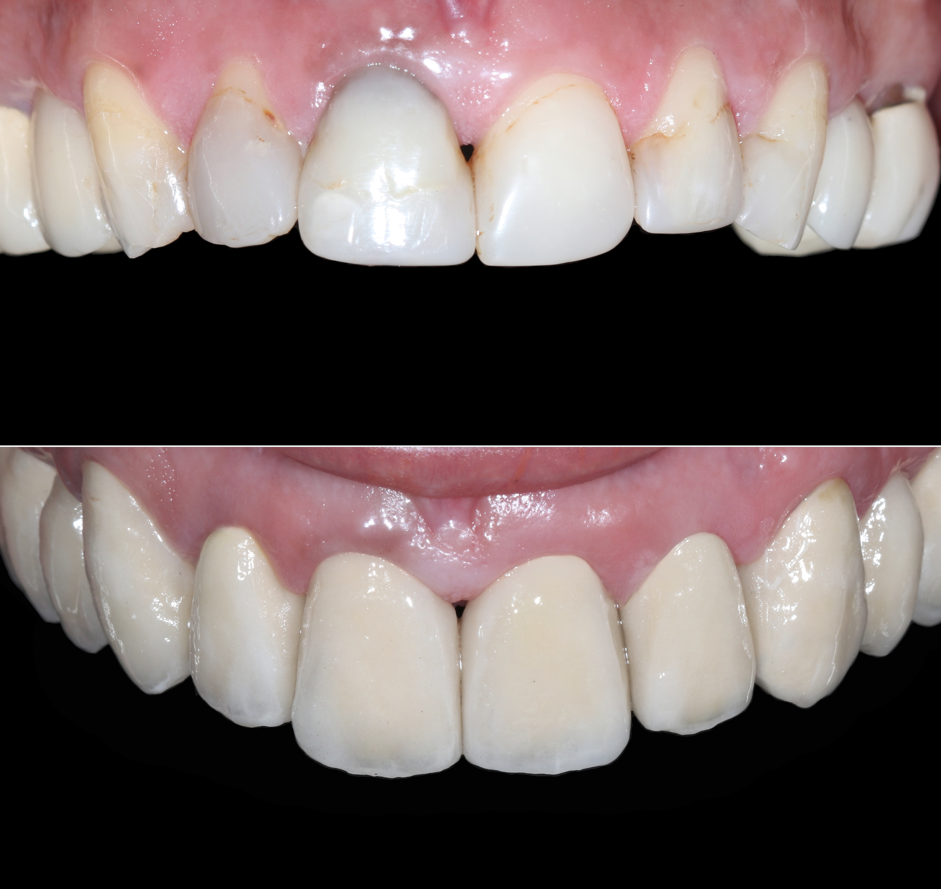 Σύγκριση αρχικής και τελικής κατάστασης στην άνω γνάθο - Πρόσθια άποψη με χρήση contraster για ανάδειξη του αποτελέσματος