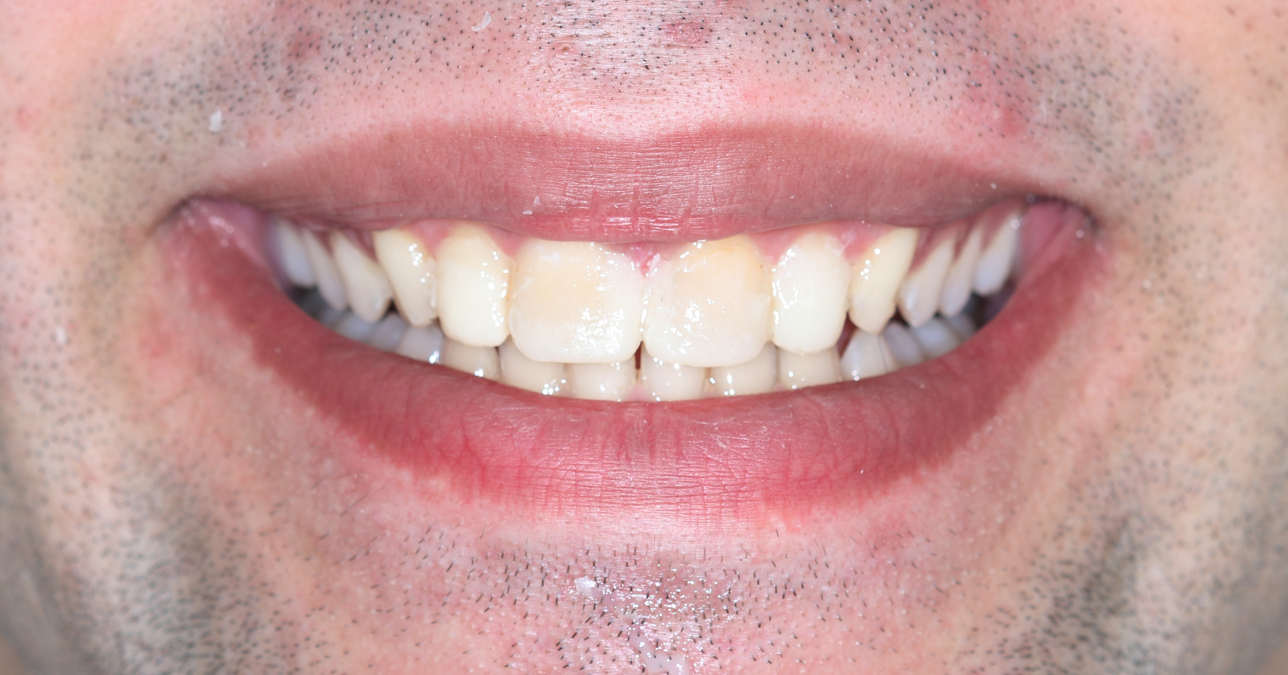 Μεταφορά του διαγνωστικού κερώματος στο στόμα ώστε ο ασθενής να αξιολογήσει το σχήματων δοντιών πριν την κατασκευή των όψεων