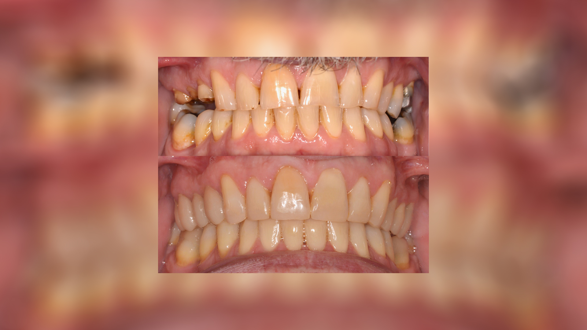 Comprehensive rehabilitation of worn dentition using bonded composite restorations and all-ceramic overlays - Dr. Klironomos