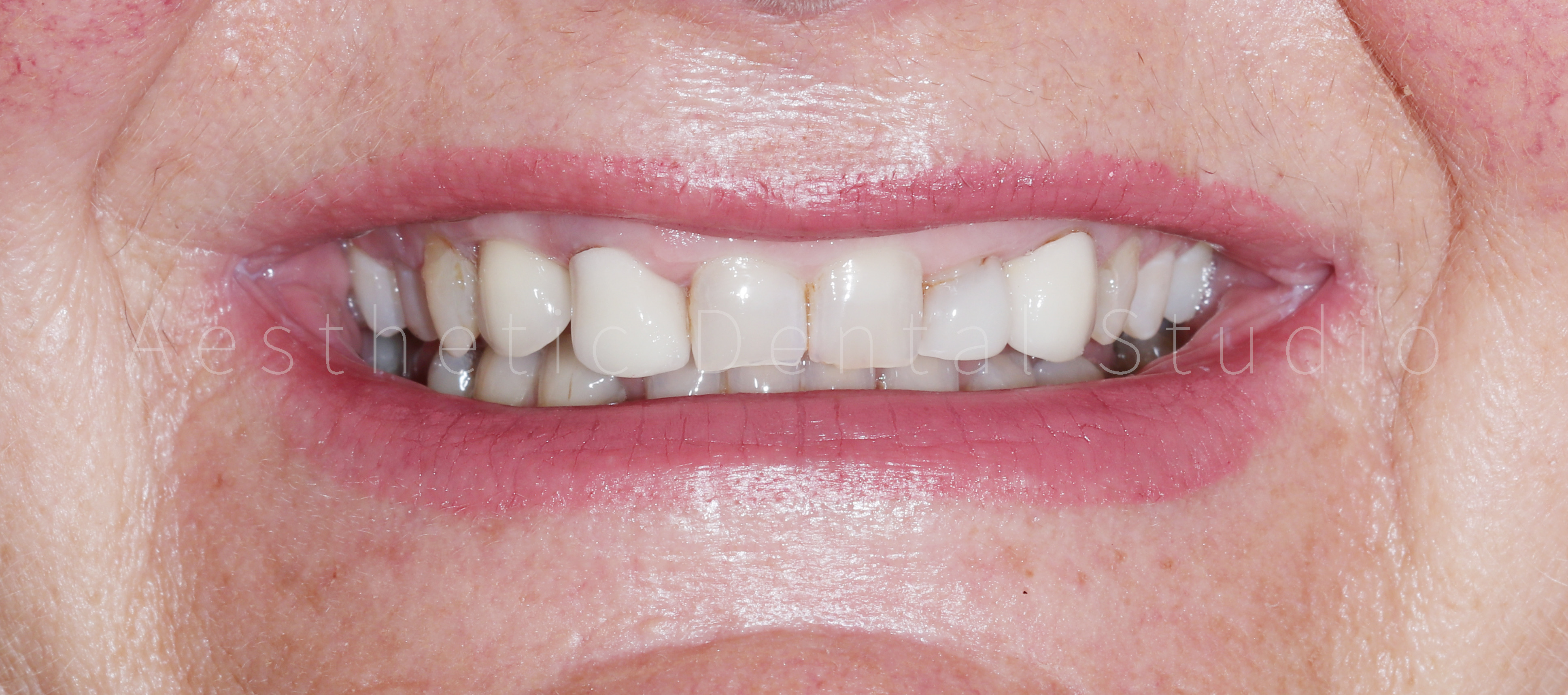 Αρχική κατάσταση – Έλλειψη αρμονίας σχημάτων, φθαρμένα δόντια και δυσχρωμικές προσθίες αποκαταστάσεις πριν την αισθητική αποκατάσταση