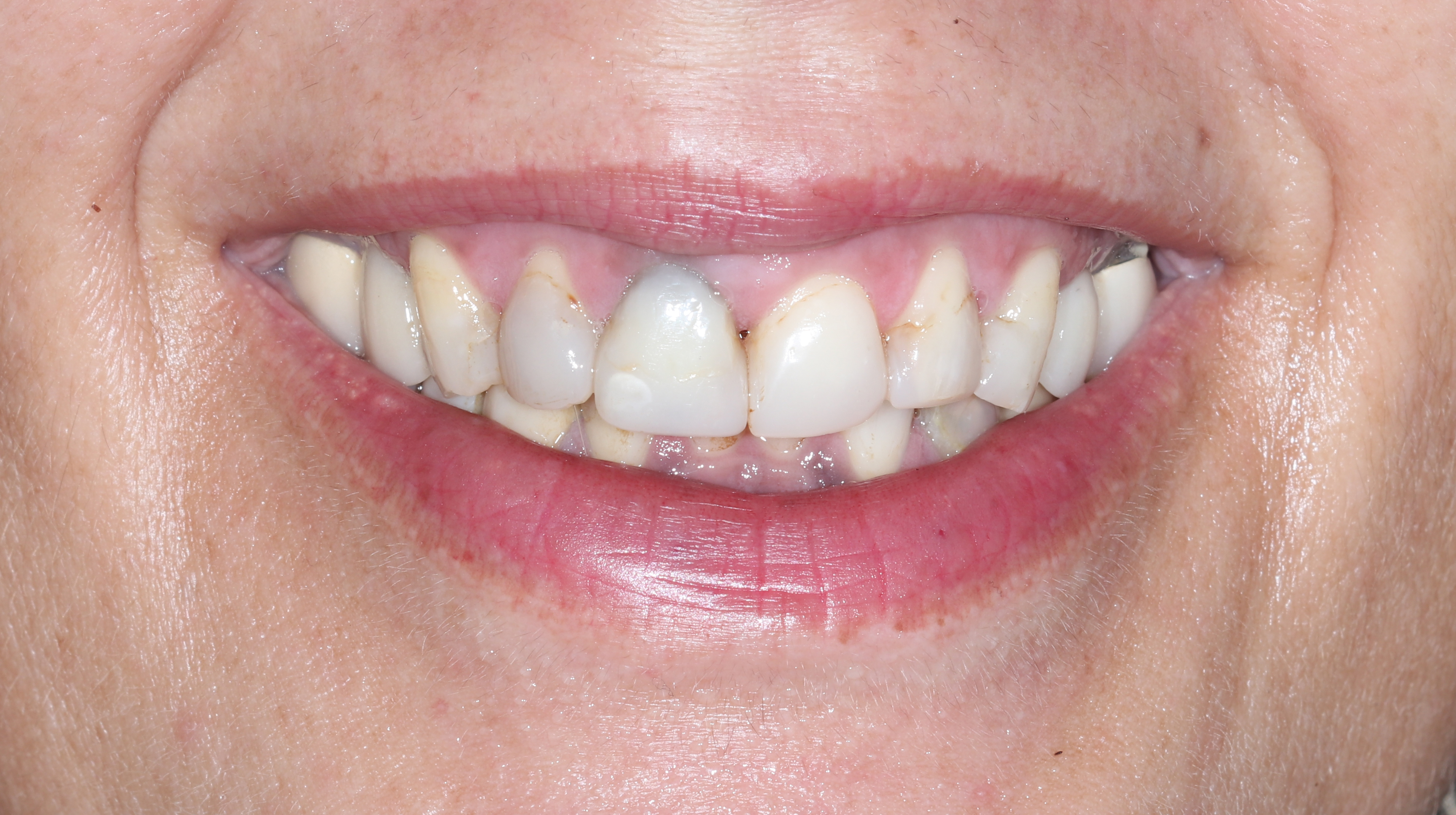 Χαμόγελο πριν την έναρξη της θεραπείας