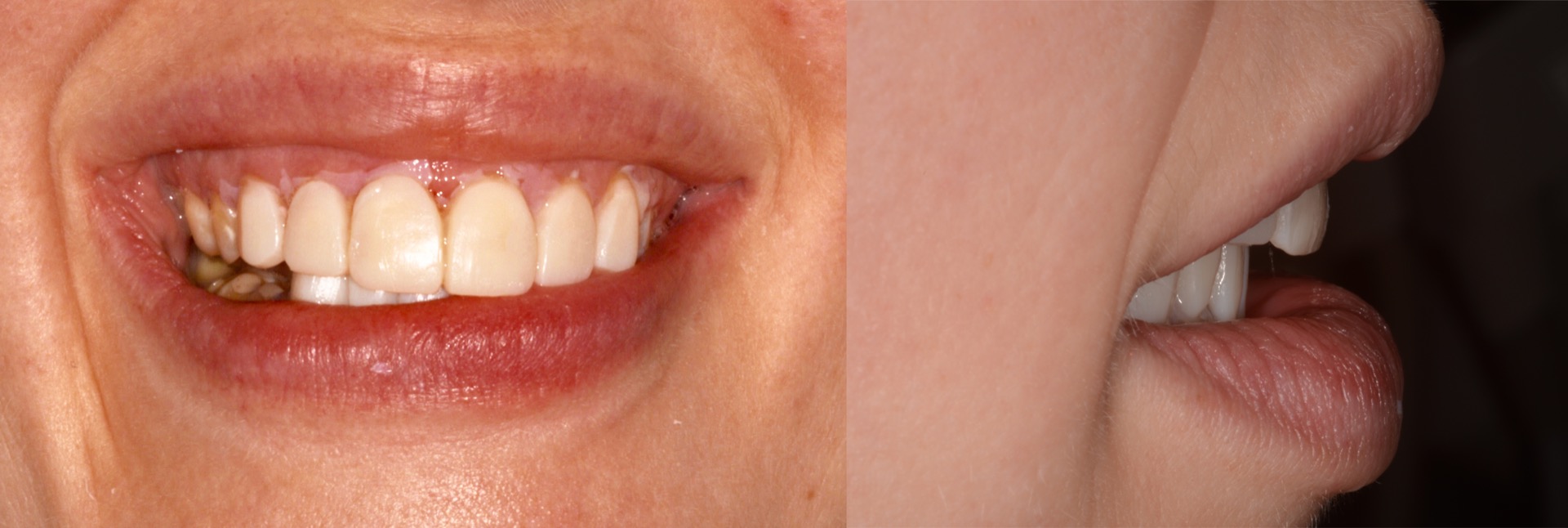 Προεπισκόπηση των τελικών αποκαταστάσεων με πλαστικό αποκαταστατικό υλικό (mock-up). Η ασθενής μπορεί να δει τις αλλαγές που θα κάνουμε στο χαμόγελό της, πριν ξεκινήσουμε την θεραπεία.