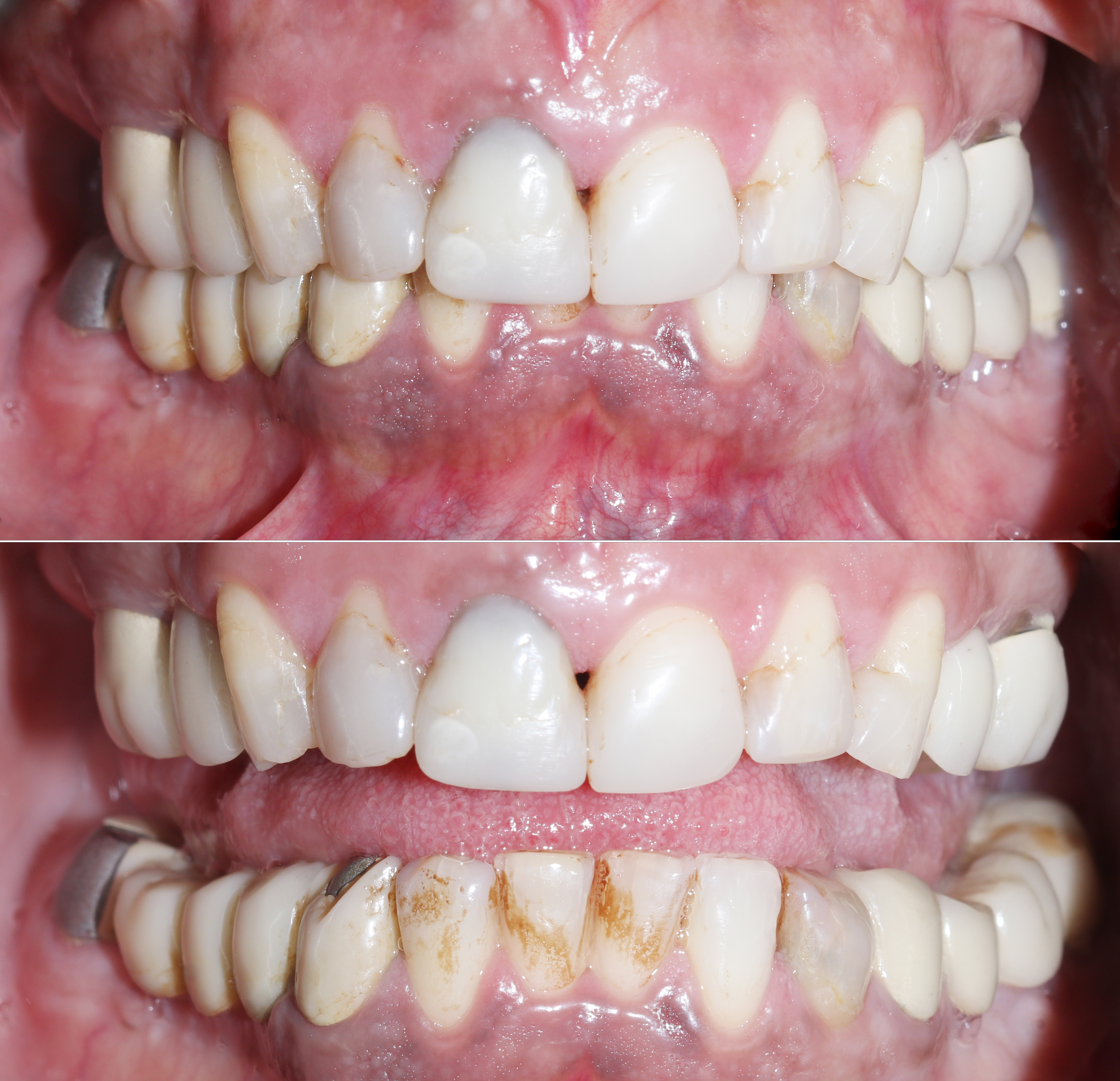 Πρόσθια άποψη πριν την αισθητική αποκατάσταση