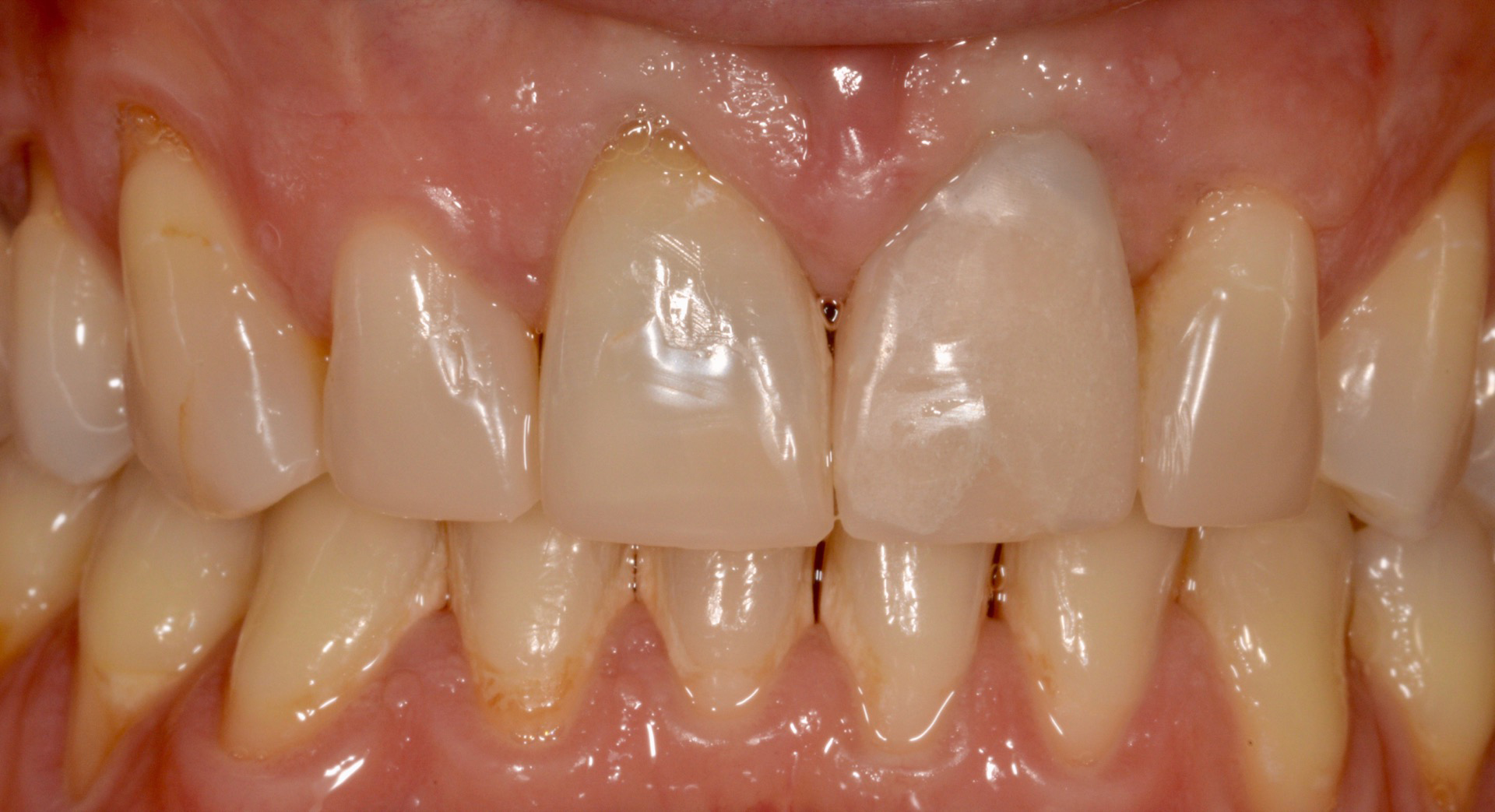 Μετά την εσωτερική λεύκανση του δεξιά τομέα και την τροποποίηση της μεταβατικής στεφάνης για την αισθητική διαμόρφωση του περιγράμματος των ούλων.