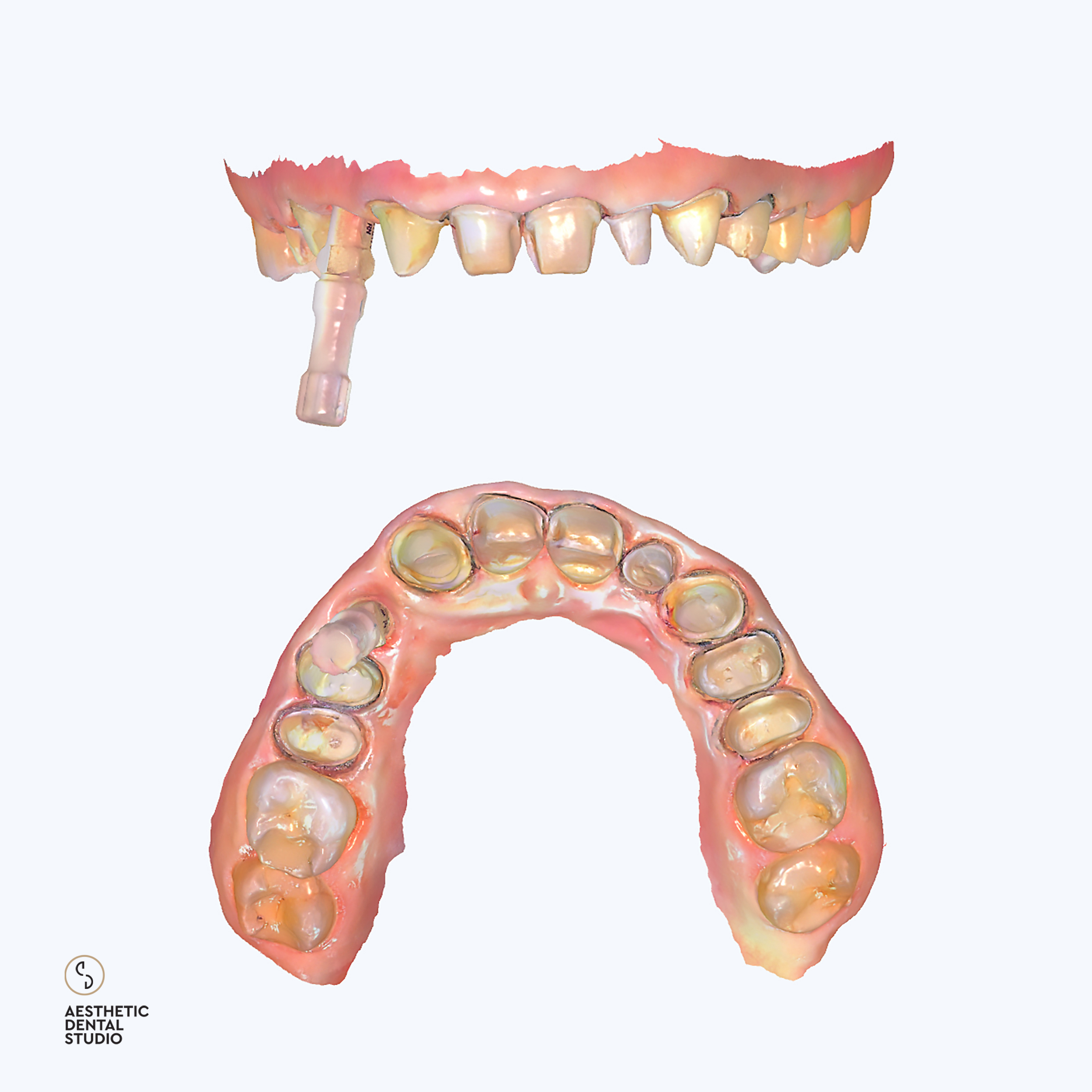 Ανακαλύψτε πώς οι ψηφιακοί ενδοστοματικοί σαρωτές (intraoral scanners) αλλάζουν την εμπειρία του ασθενή και την ακρίβεια των αποκαταστάσεων. Στο Aesthetic Dental Studio του Θεόδωρου Κληρονόμου, η ψηφιακή αποτύπωση προσφέρει ανώτερη ακρίβεια, ταχύτητα και άνεση χωρίς τα παραδοσιακά αποτυπώματα.