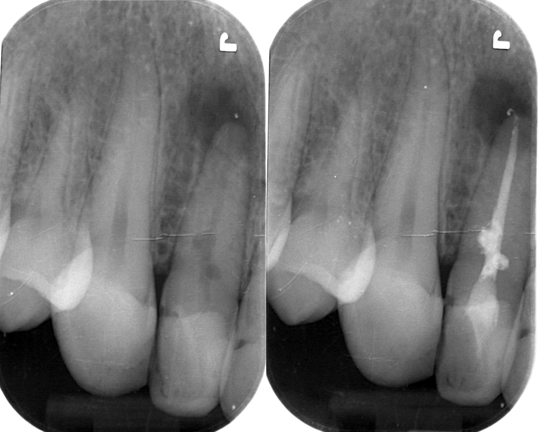 Αρχική και τελική ακτινογραφία του πλάγιου τομέα - Εσωτερική απορρόφηση της ρίζας και απόστημα (αριστερά) - Επιτυχής ενδοδοντική θεραπεία (απονεύρωση) με τρισδιάστατη έμφραξη της απορρόφησης (δεξιά)