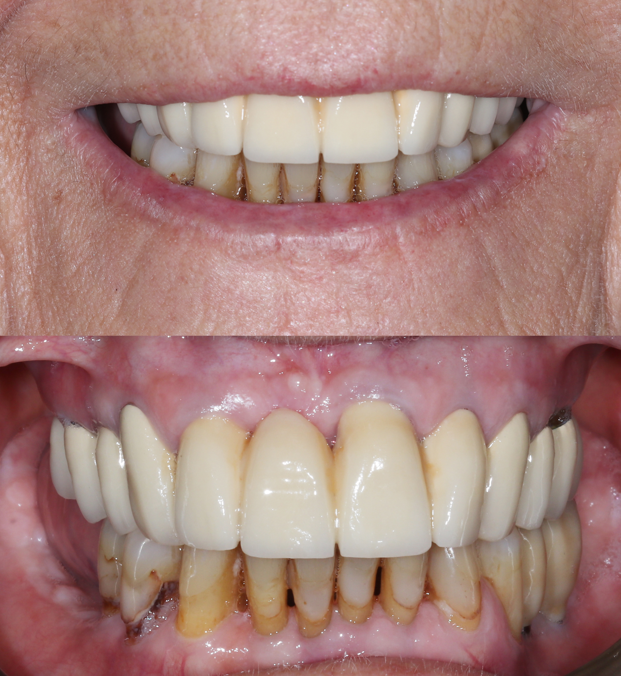 Αρχική κατάσταση - Χαμόγελο και πρόσθια άποψη