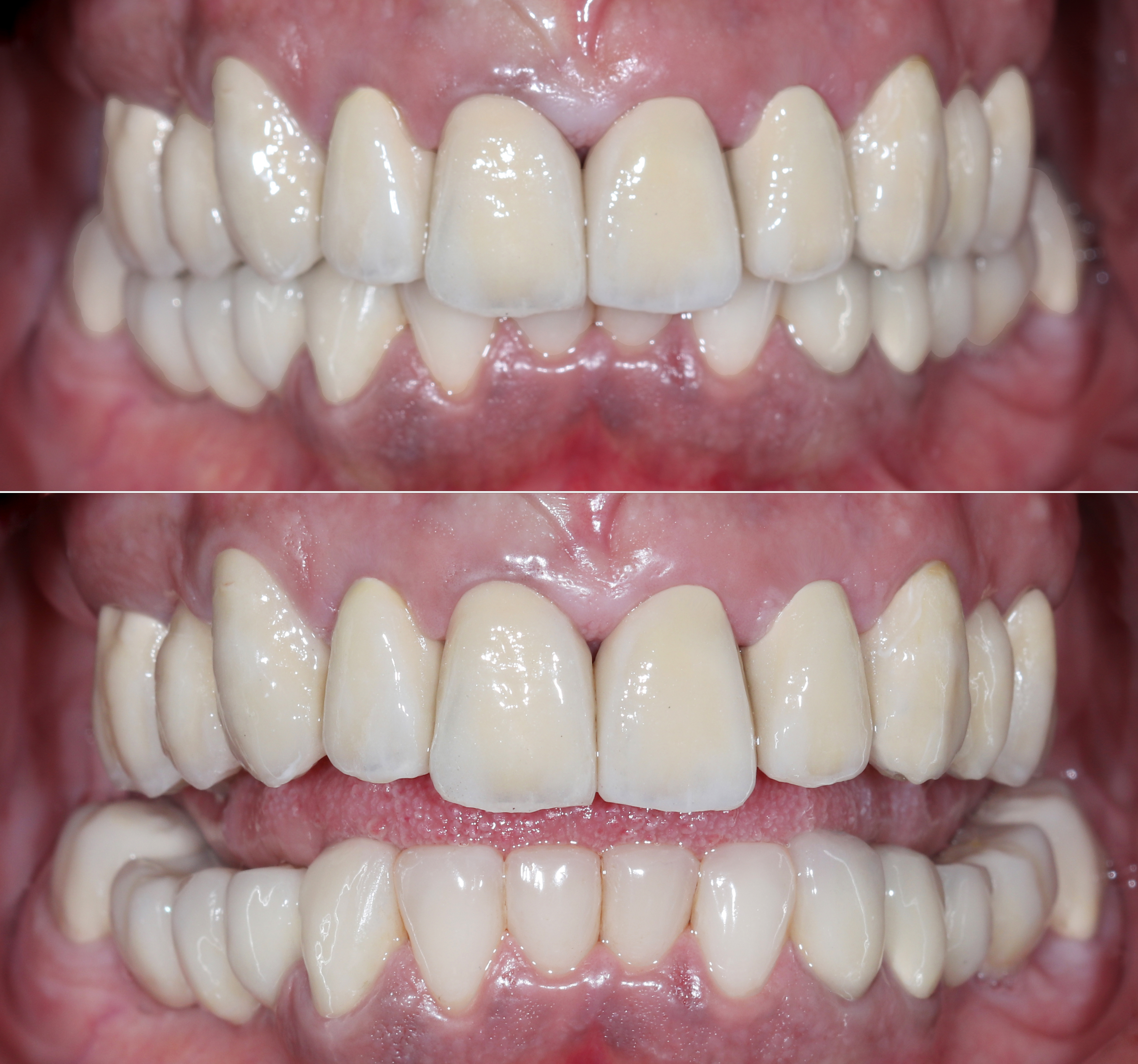 Πρόσθια άποψη μετά την αισθητική αποκατάσταση