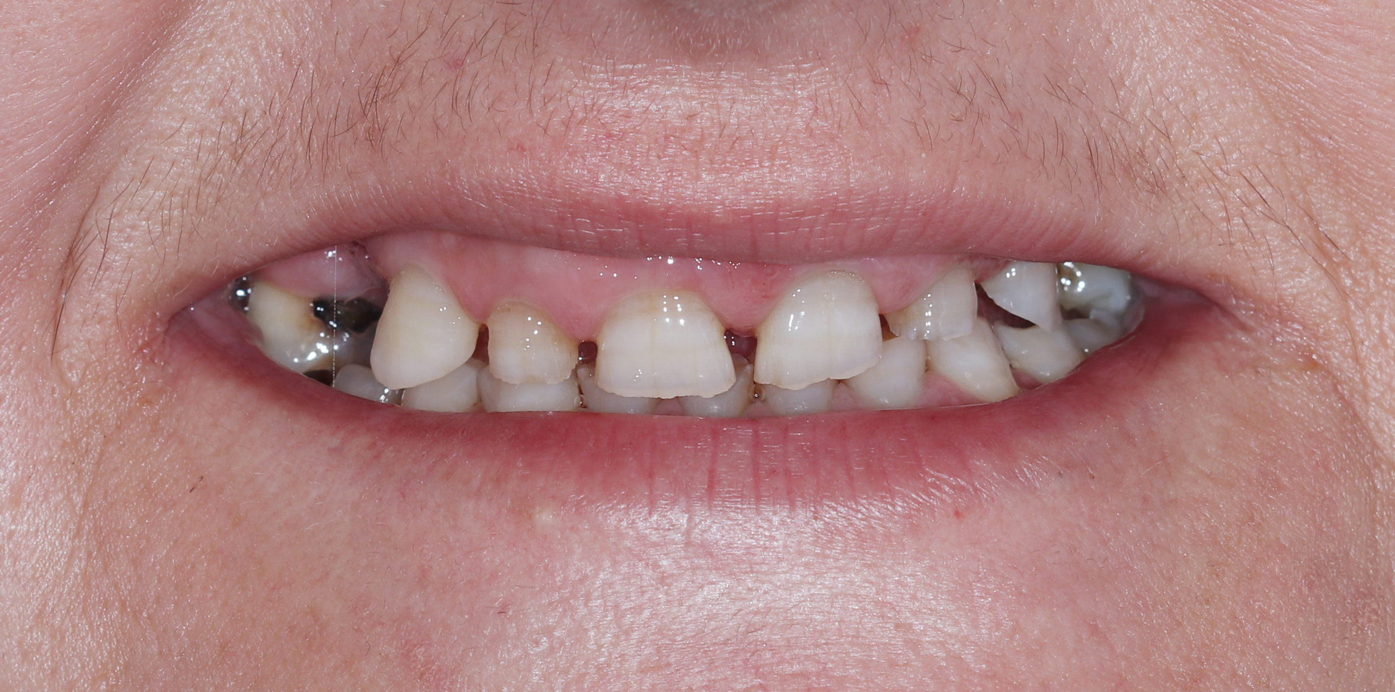 Αρχική κατάσταση - Χαμόγελο 