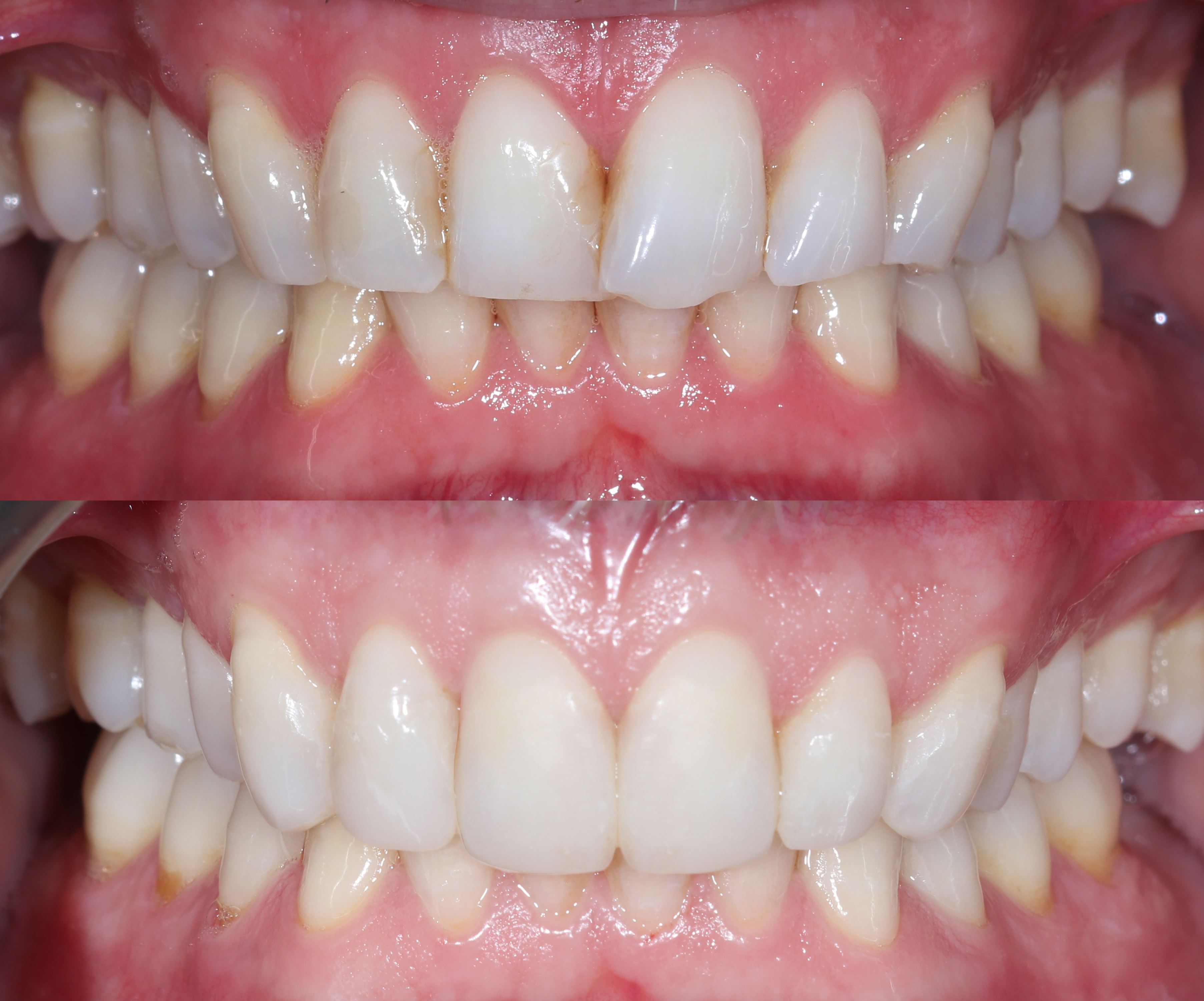 Σύγκριση αρχικής και τελικής κατάστασης – Πρόσθια άποψη