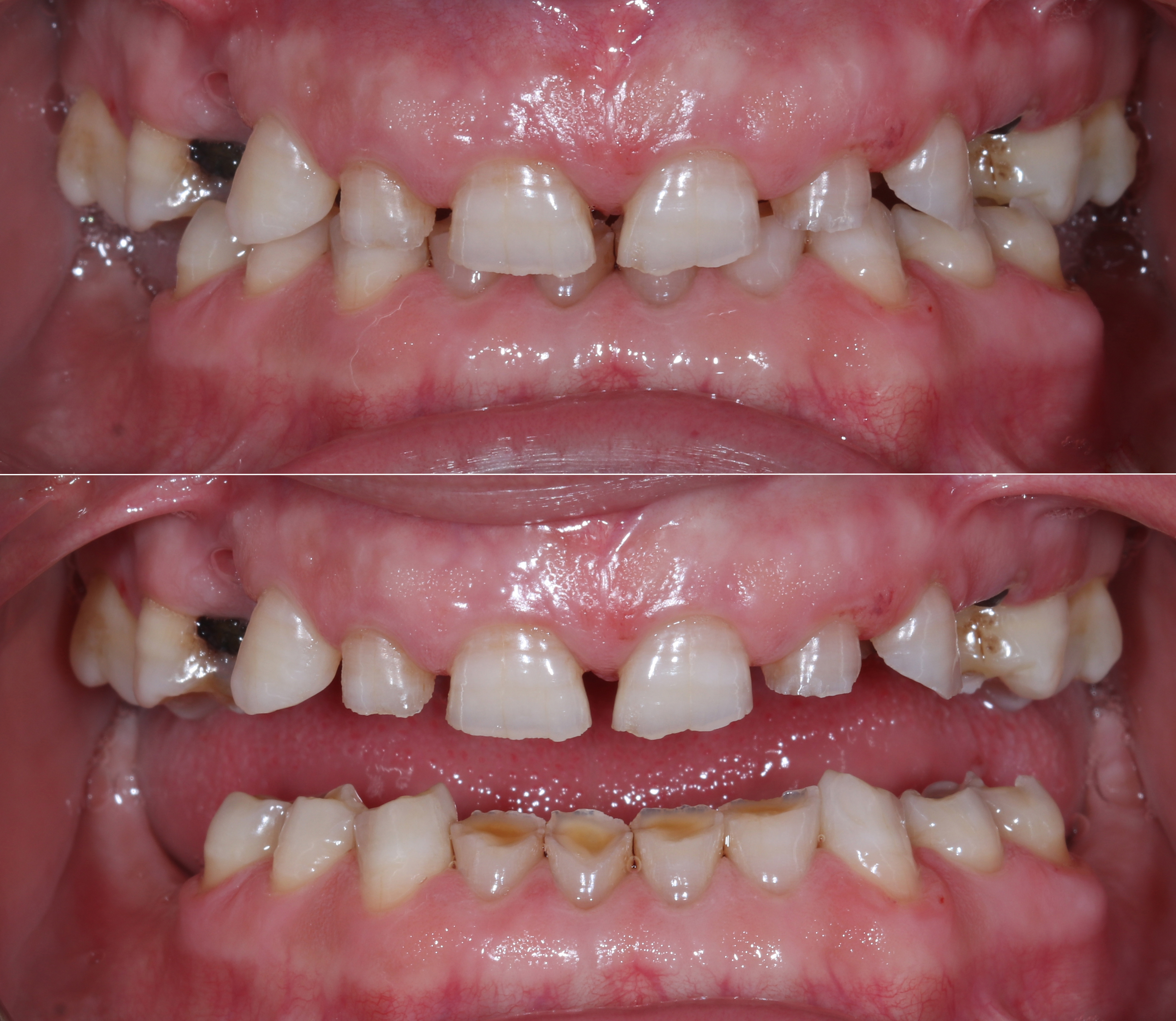 Αρχική κατάσταση - Πρόσθια άποψη - Αραιοδοντία, εκτεταμένη οδοντική φθορά (διαβρώσεις και αποτριβές),  τερηδόνες και έλλειψη δοντιών