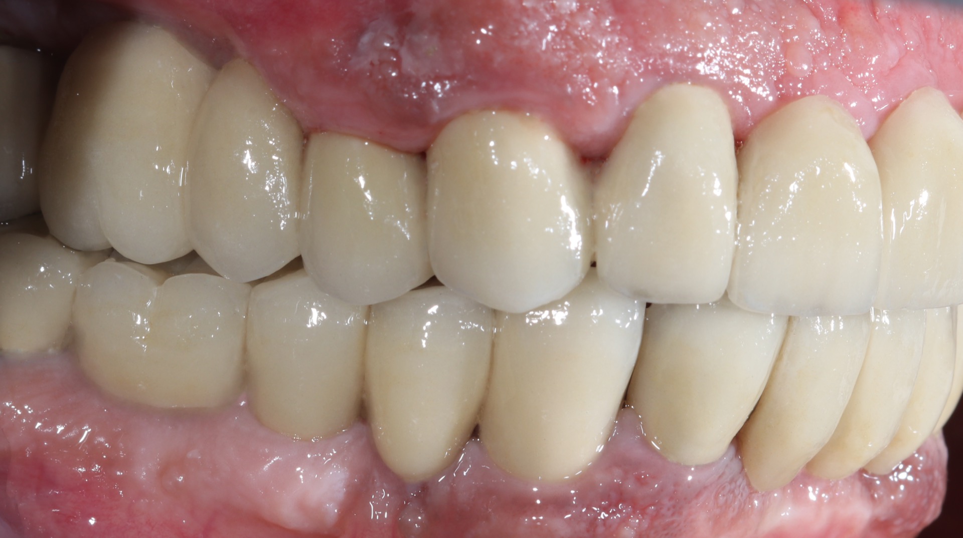 Τελική κατάσταση - Δεξιά άποψη.