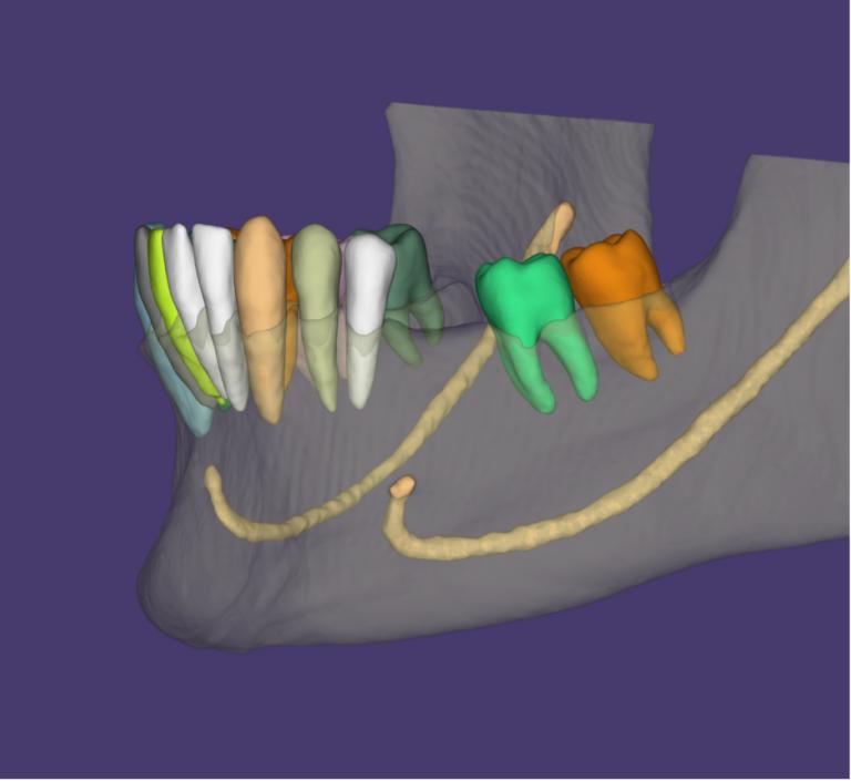 Η τεχνολογία CBCT βοηθά τον Dr. Κληρονόμος να πραγματοποιεί ακριβή ψηφιακό σχεδιασμό εμφυτευμάτων και σύνθετων οδοντιατρικών θεραπειών στην Καλαμάτα.