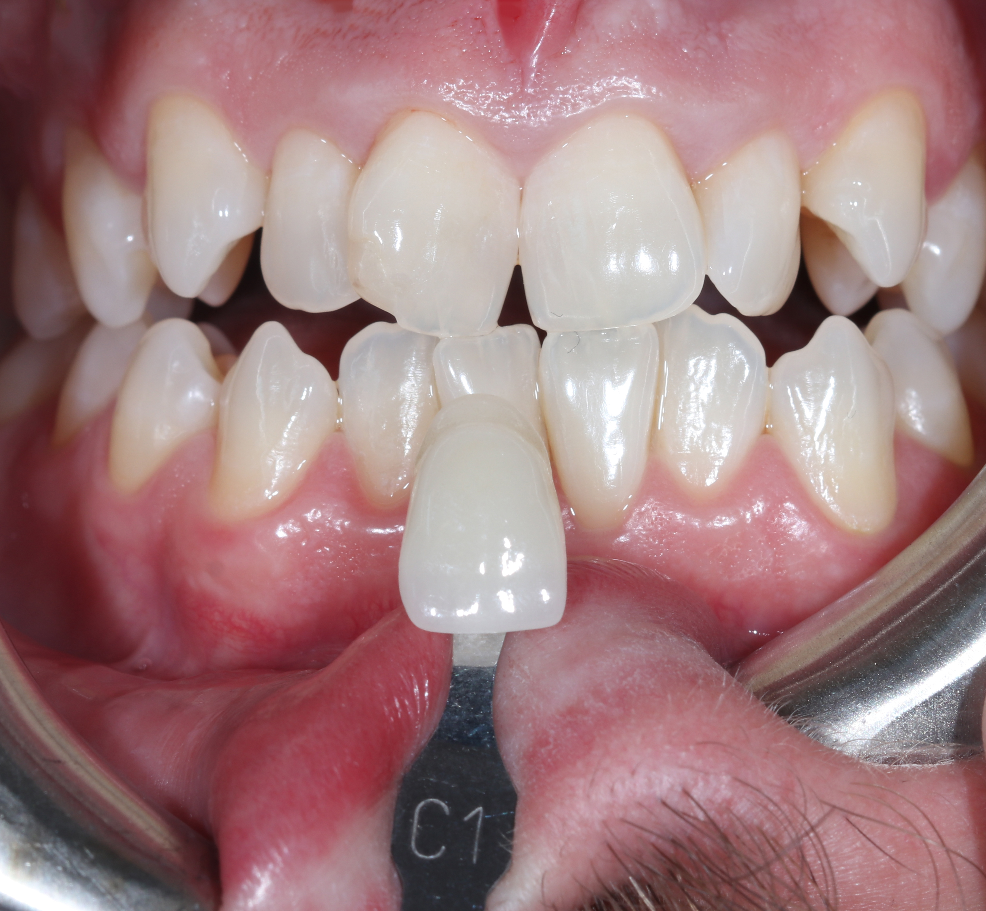 Το χρώμα των δοντιών μετά από συνδυασμό λεύκανσης στο σπίτι με εξατομικευμένους νάρθηκες και στο ιατρείο