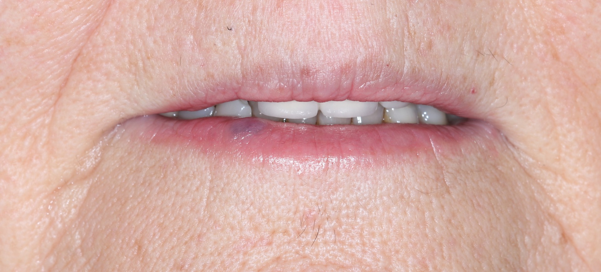 Αρχική κατάσταση - Χείλη σε ανάπαυση.