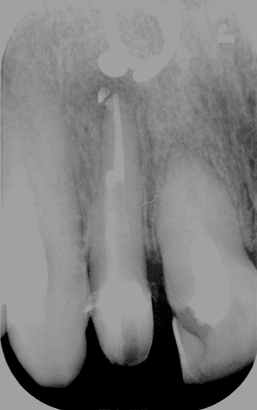 Τελική κατάσταση - Αφαίρεση του σπασμένου εργαλείου και επιτυχής ενδοδοντική θεραπεία του δοντιού