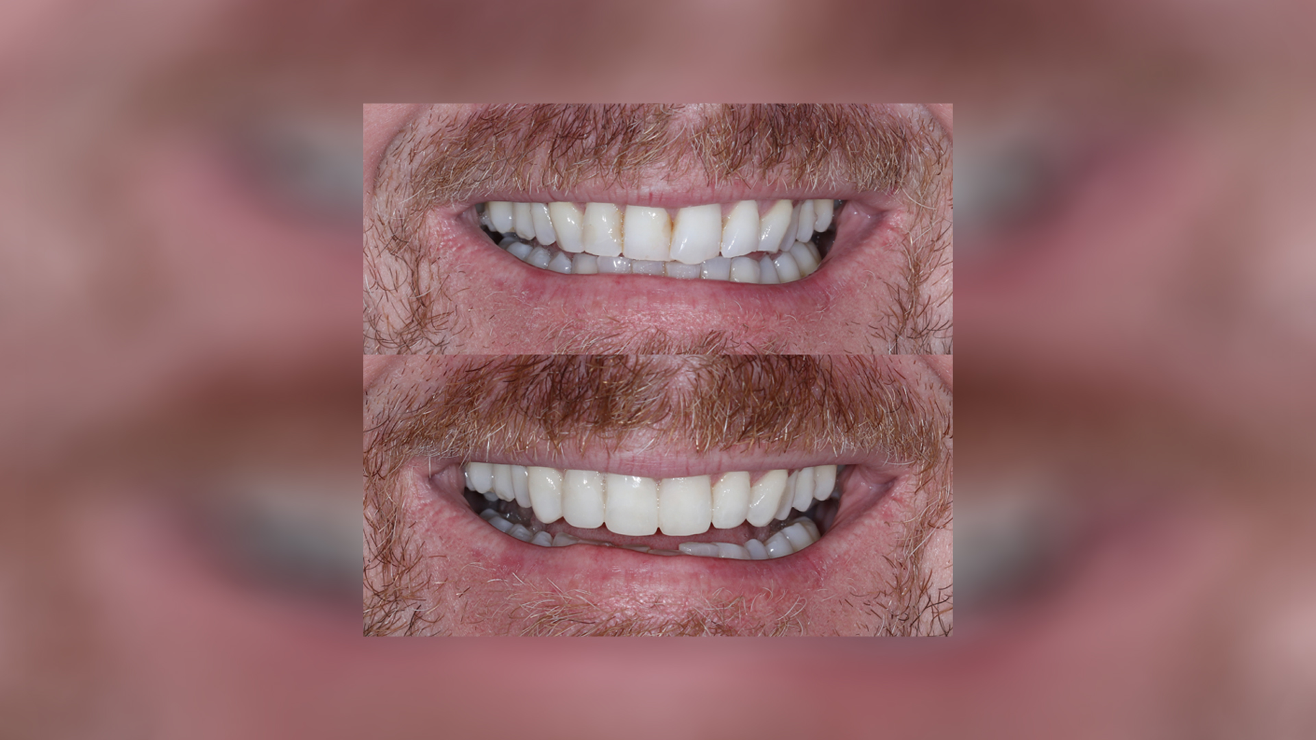 Αισθητική διόρθωση συνωστισμού και φθοράς προσθίων δοντιών με λεύκανση και άμεσες αποκαταστάσεις ρητίνης