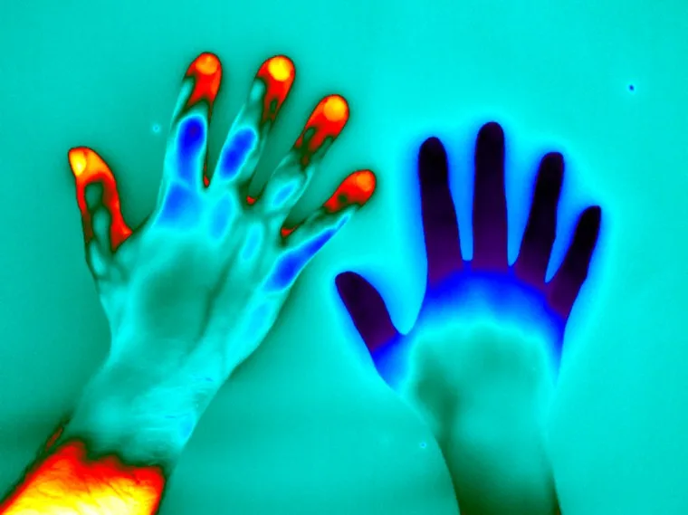 Raynaud's Phenomenon Thermal Vision Research, Wellcome Collection, United Kingdom, CC BY