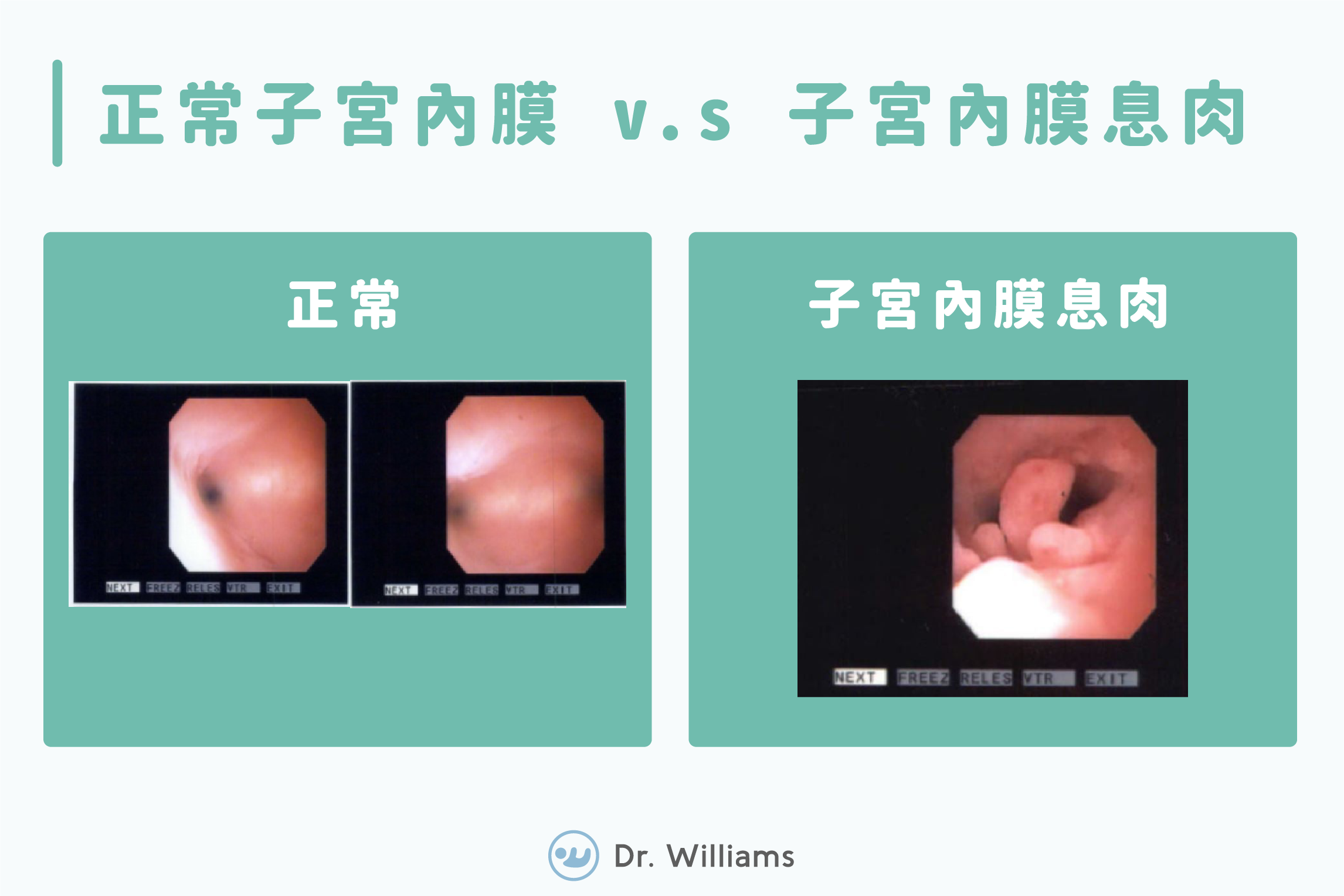 子宮息肉影響生育力？擊敗子宮瘜肉還子宮乾淨的房間！