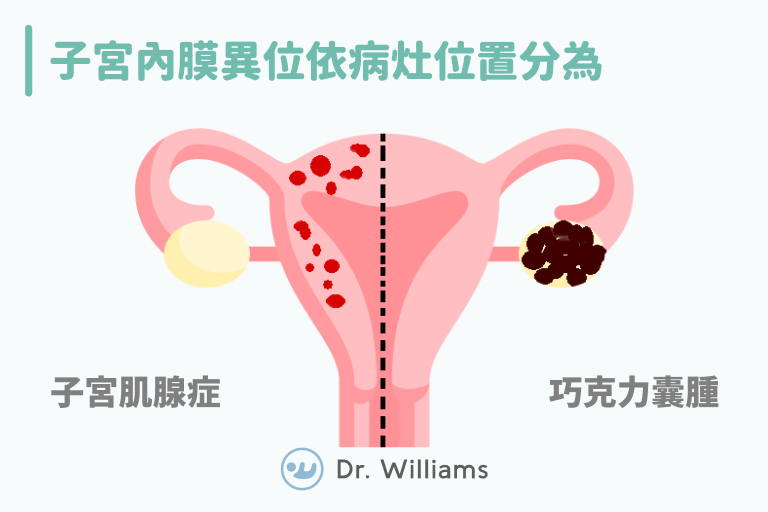 子宮內膜異位是不孕症的隱形殺手？放心！我來拯救妳！