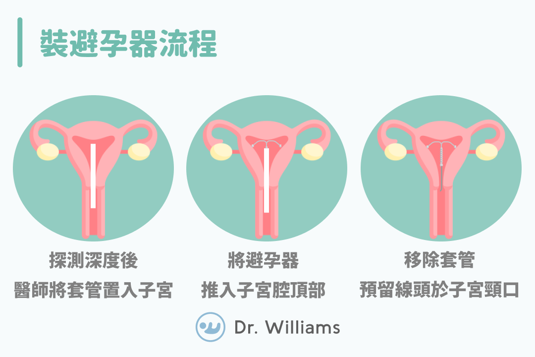 避孕器效果好嗎？會痛嗎？多少錢？不藏私大公開！