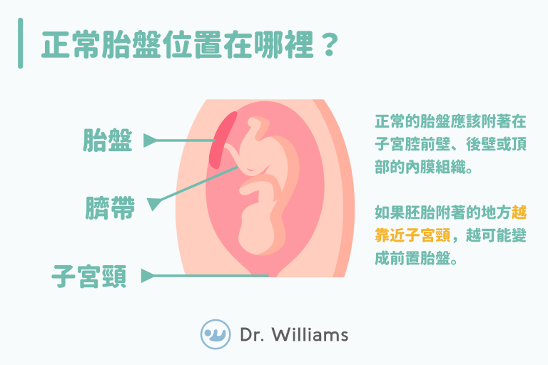 前置胎盤一點也不可怕！讓醫師教妳平時怎麼做！