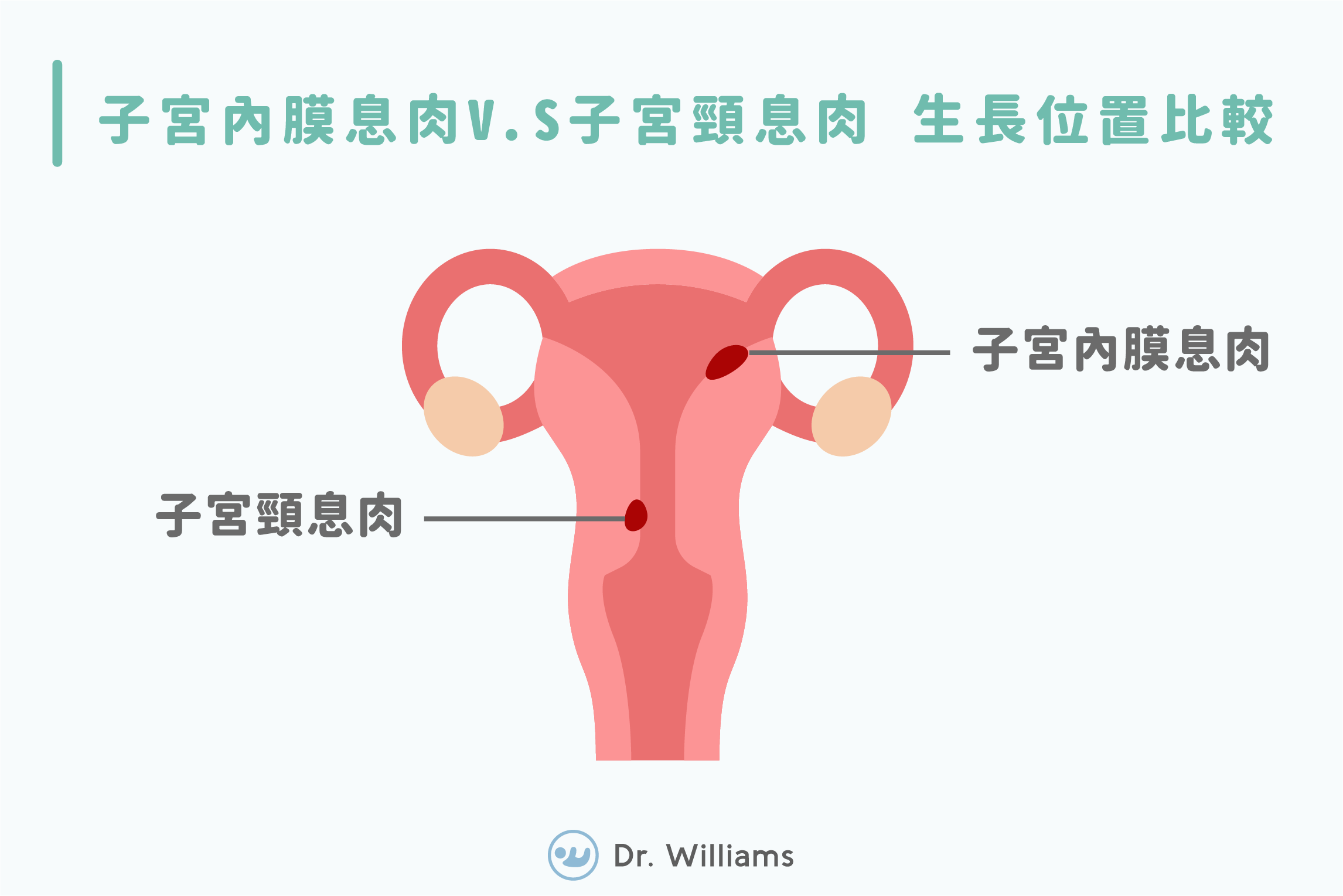 子宮瘜肉是什麼？移除子宮息肉懷孕更容易？醫師圖文說明