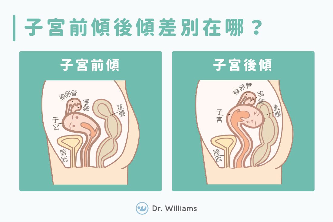 子宮後傾懷孕機率高嗎？子宮後傾改善、迷思大公開！