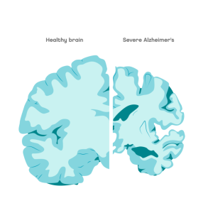 Comparison between a normal looking brain and a brain with Alzheimer’s. A similar process occurs in dementia in pets.