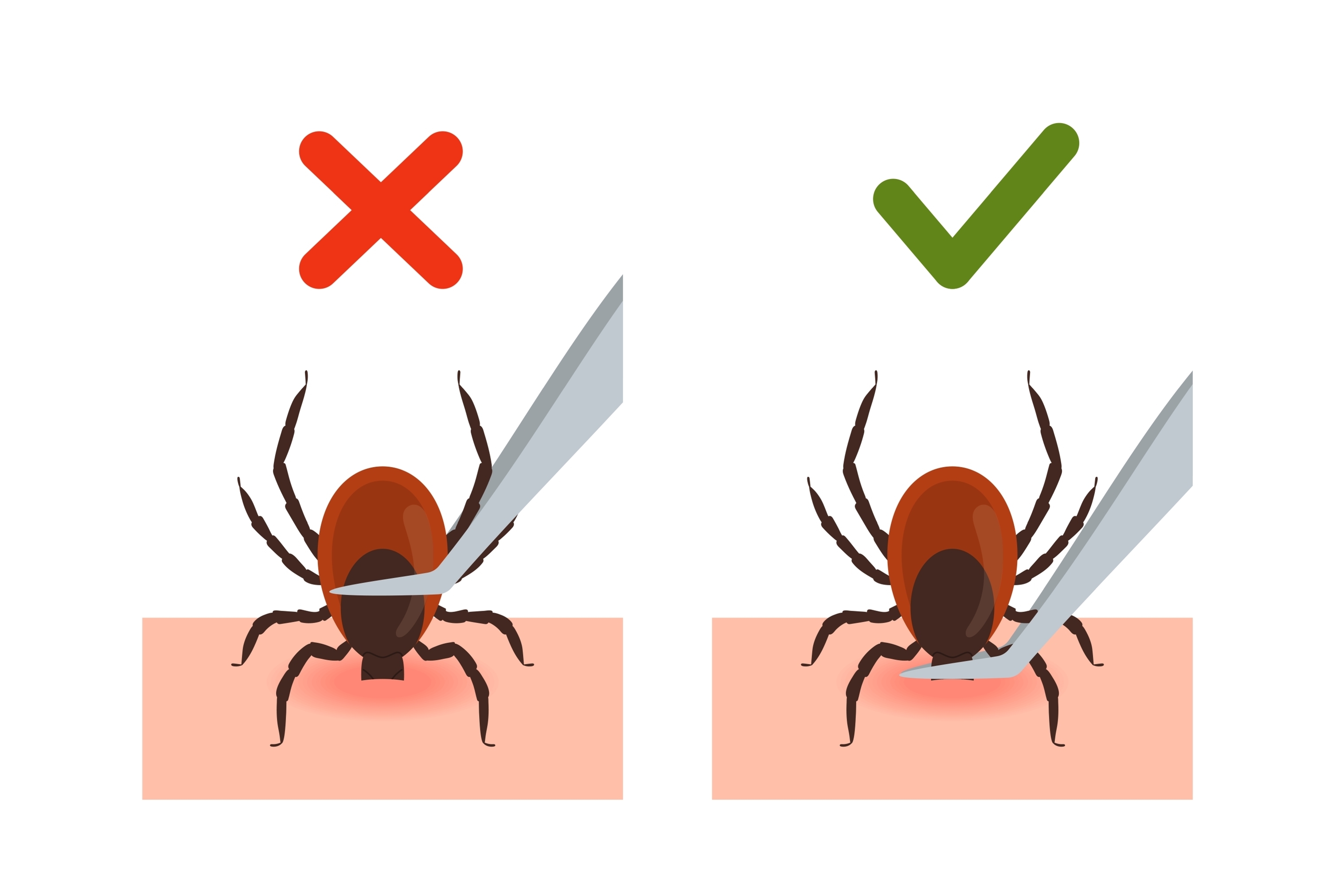 Correct method of tick removal