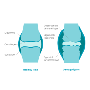 Arthritic joints