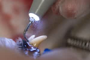 Tooth scaling