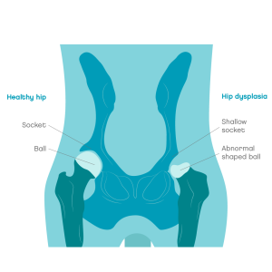 Hip dysplasia in dogs