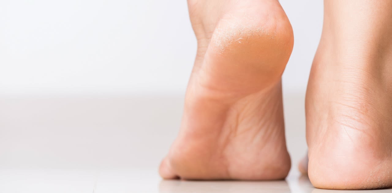 image - Magazine | Piedi secchi cause e rimedi