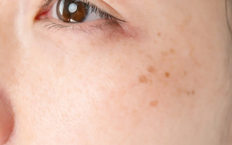 Hero mobile - Macchie e Cicatrici - Rilastil