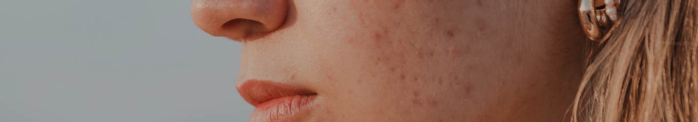 image - Pelle acneica: i migliori prodotti skincare per contrastare imperfezioni e riequilibrare il sebo