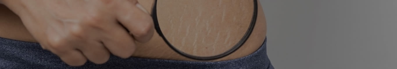 image - Smagliature bianche e rosse