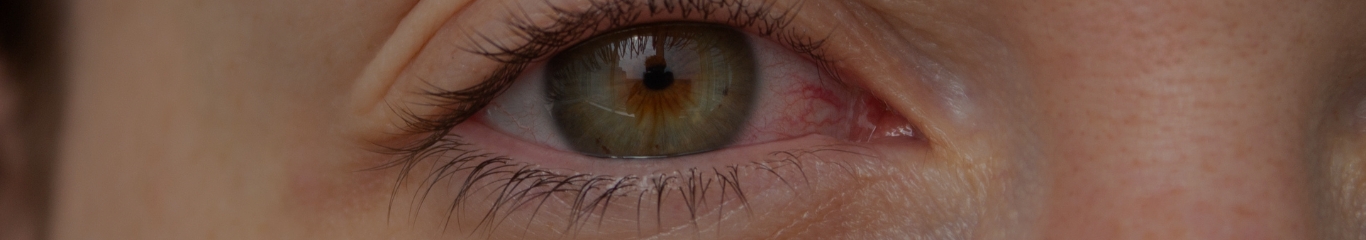 image - Olopatadina: cos’è, come funziona e quando usarla contro le allergie