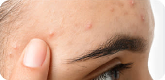 image - dermocosmesi-pelle-tendenza-acneica