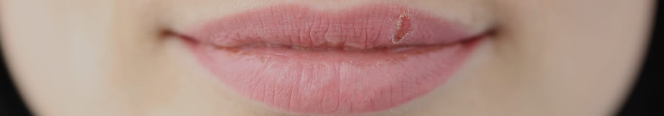 Herpes Simplex: sintomi, contagio e prevenzione